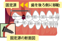 固定源の断面図歯を後ろ側に移動固定源