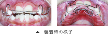 装着時の様子