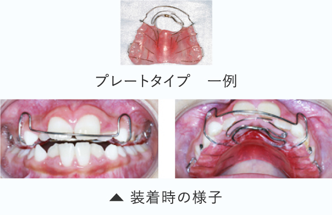 装着時の様子 プレートタイプ 一例