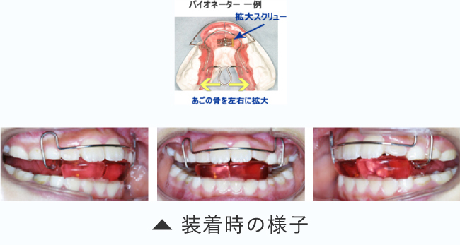 装着時の様子 プレートタイプ 一例